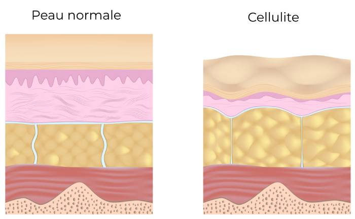 Illustration de la cellulite